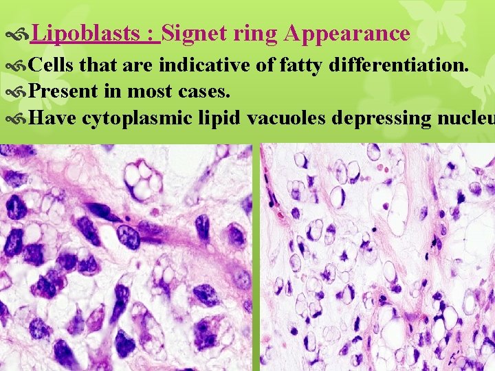  Lipoblasts : Signet ring Appearance Cells that are indicative of fatty differentiation. Present