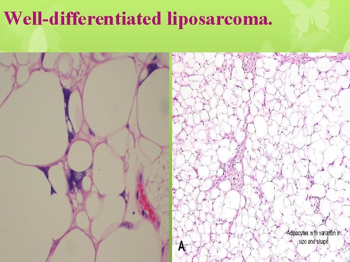 Well-differentiated liposarcoma. 