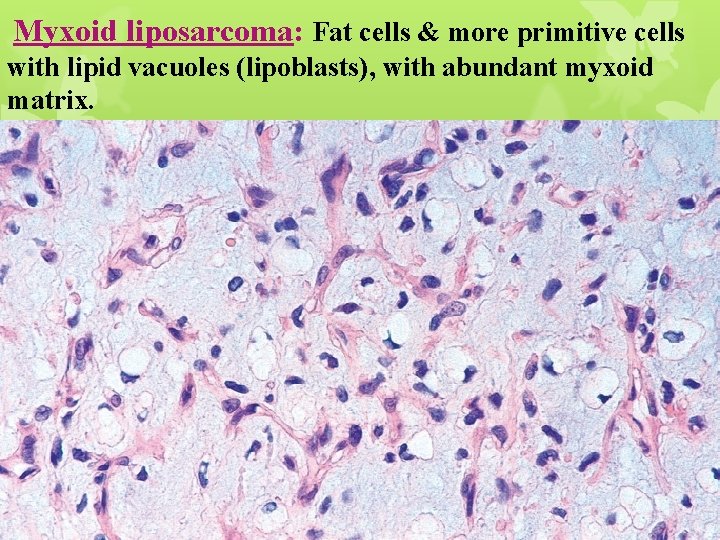 Myxoid liposarcoma: Fat cells & more primitive cells with lipid vacuoles (lipoblasts), with abundant