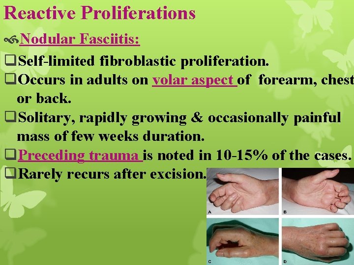 Reactive Proliferations Nodular Fasciitis: q. Self-limited fibroblastic proliferation. q. Occurs in adults on volar