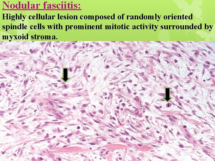 Nodular fasciitis: Highly cellular lesion composed of randomly oriented spindle cells with prominent mitotic