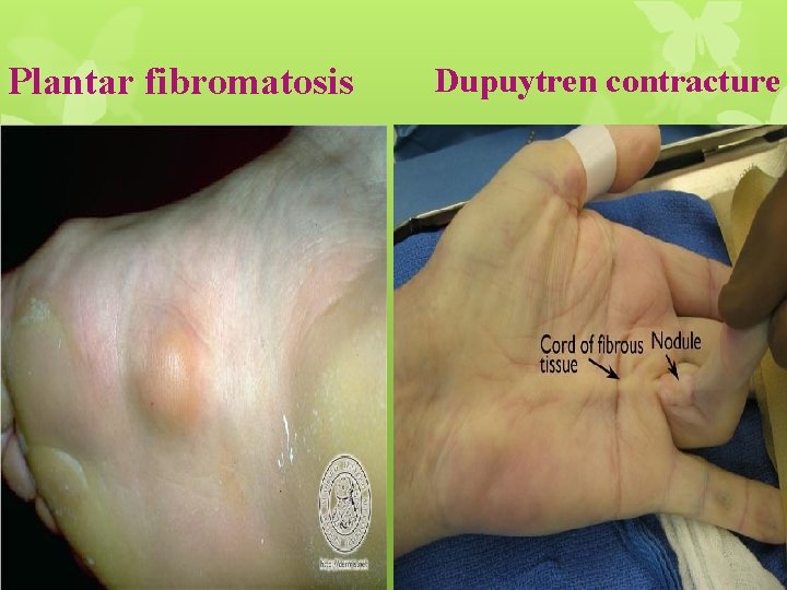 Plantar fibromatosis Dupuytren contracture 