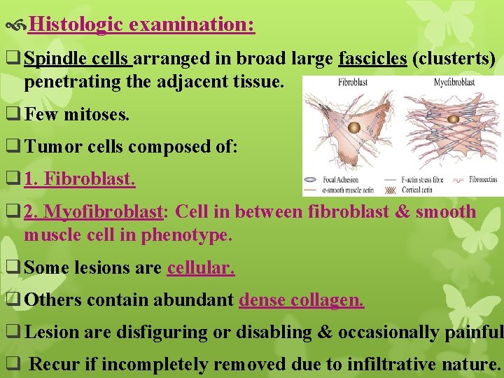  Histologic examination: q Spindle cells arranged in broad large fascicles (clusterts) penetrating the