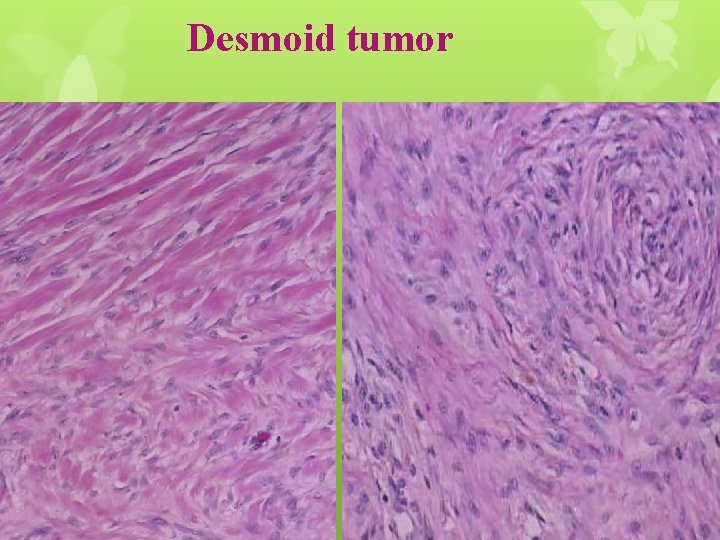 Desmoid tumor 