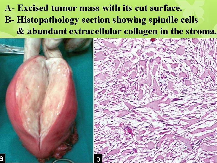 A- Excised tumor mass with its cut surface. B- Histopathology section showing spindle cells