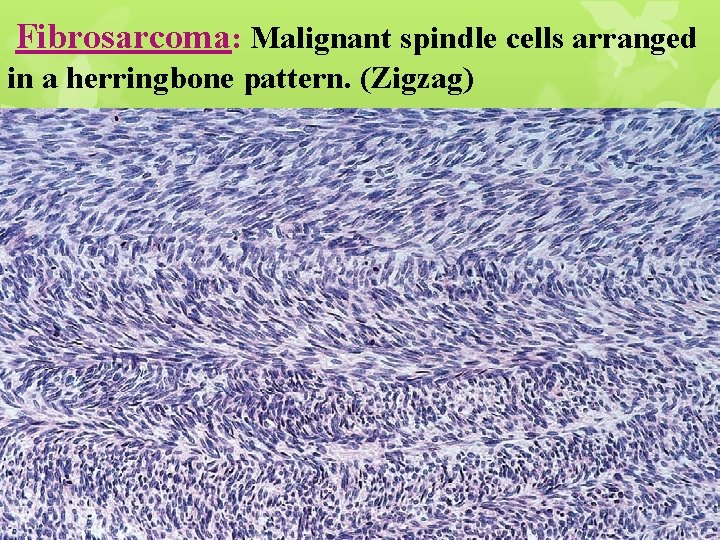 Fibrosarcoma: Malignant spindle cells arranged in a herringbone pattern. (Zigzag) 