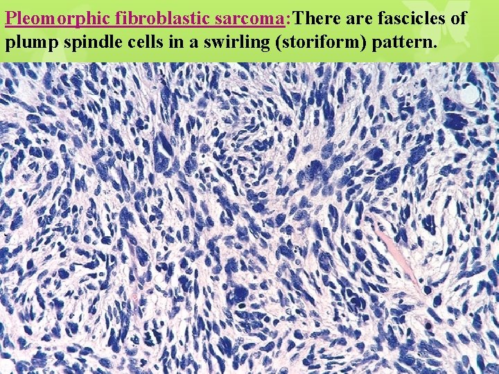 Pleomorphic fibroblastic sarcoma: There are fascicles of plump spindle cells in a swirling (storiform)