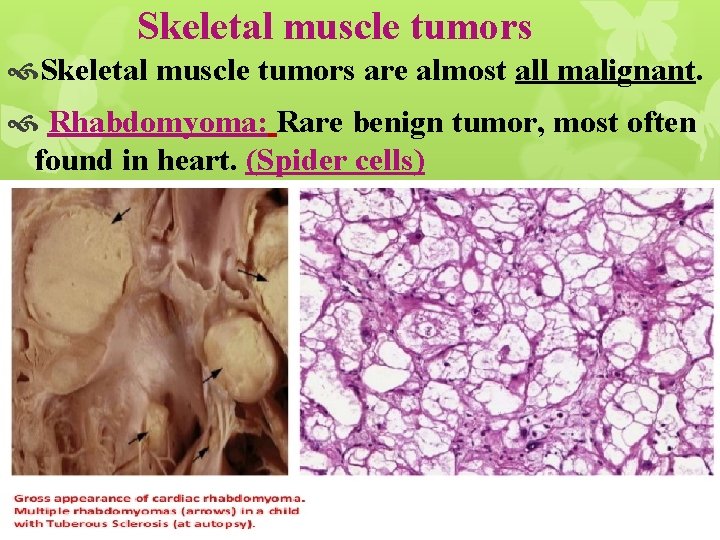 Skeletal muscle tumors are almost all malignant. Rhabdomyoma: Rare benign tumor, most often found