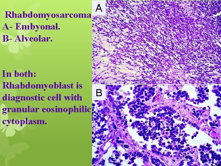 Rhabdomyosarcoma A- Embyonal. B- Alveolar. In both: Rhabdomyoblast is diagnostic cell with granular eosinophilic