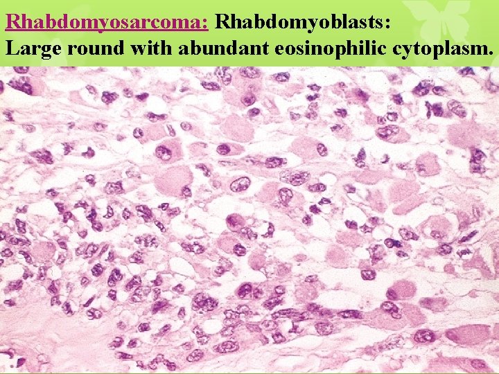 Rhabdomyosarcoma: Rhabdomyoblasts: Large round with abundant eosinophilic cytoplasm. 