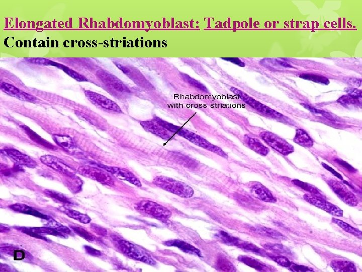 Elongated Rhabdomyoblast: Tadpole or strap cells. Contain cross-striations 