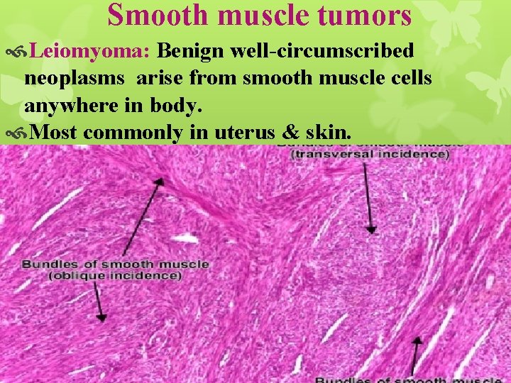 Smooth muscle tumors Leiomyoma: Benign well-circumscribed neoplasms arise from smooth muscle cells anywhere in