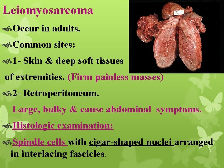 Leiomyosarcoma Occur in adults. Common sites: 1 - Skin & deep soft tissues of