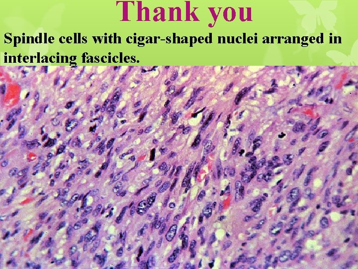 Thank you Spindle cells with cigar-shaped nuclei arranged in interlacing fascicles. 