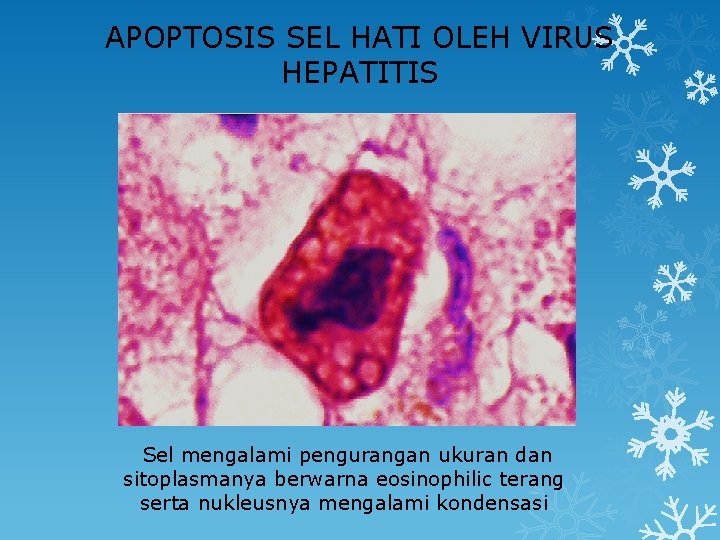 APOPTOSIS SEL HATI OLEH VIRUS HEPATITIS Sel mengalami pengurangan ukuran dan sitoplasmanya berwarna eosinophilic