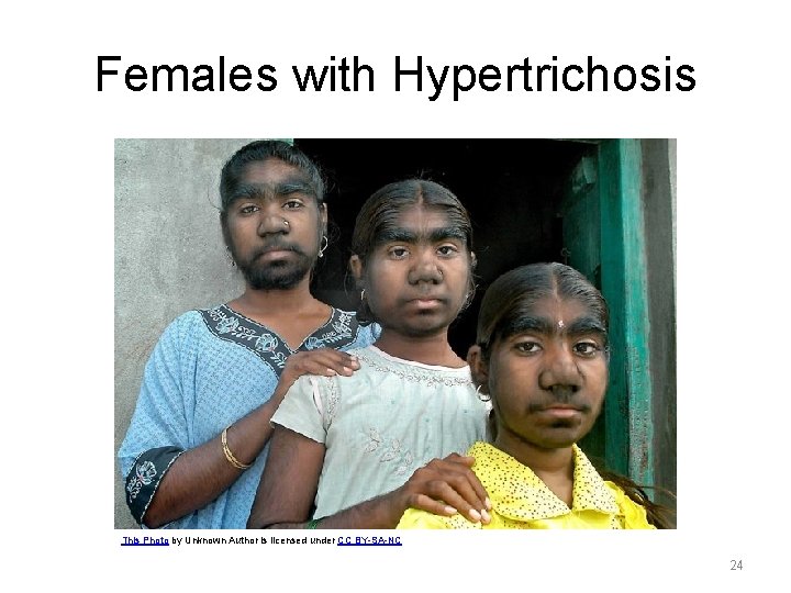 Females with Hypertrichosis This Photo by Unknown Author is licensed under CC BY-SA-NC 24 Females with Hypertrichosis This Photo by Unknown Author is licensed under CC BY-SA-NC 24