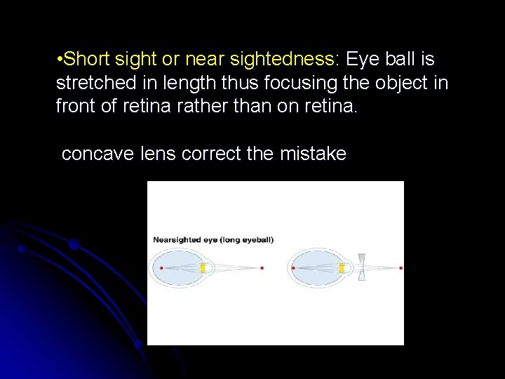  • Short sight or near sightedness: Eye ball is stretched in length thus