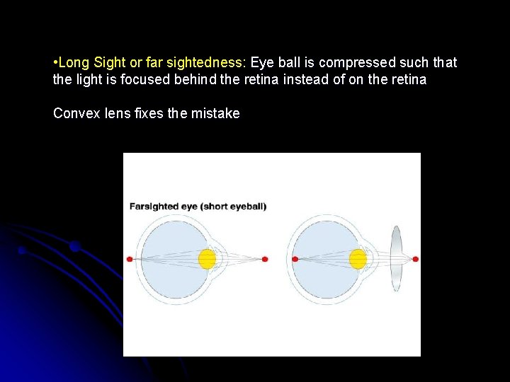  • Long Sight or far sightedness: Eye ball is compressed such that the