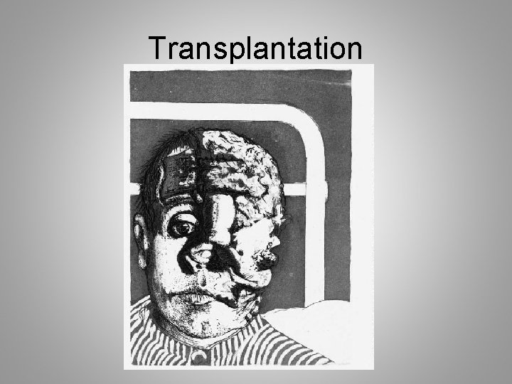 Transplantation 
