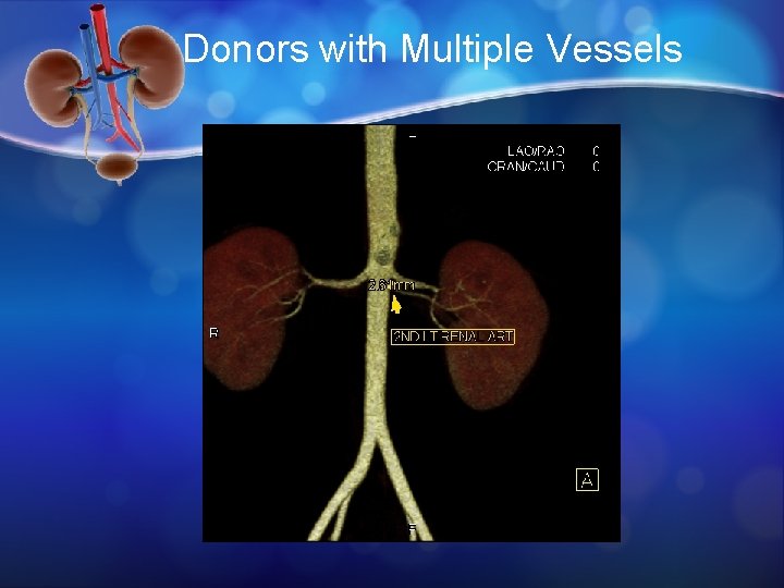 Donors with Multiple Vessels 