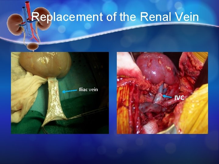 Replacement of the Renal Vein Iliac vein IVC 