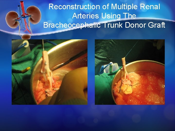 Reconstruction of Multiple Renal Arteries Using The Bracheocephalic Trunk Donor Graft 