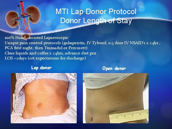 MTI Lap Donor Protocol Donor Length of Stay 100% Hand- assisted Laparoscopic Unique pain