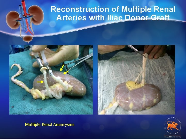 Reconstruction of Multiple Renal Arteries with Iliac Donor Graft Multiple Renal Aneurysms 