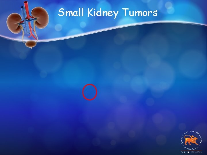 Small Kidney Tumors 
