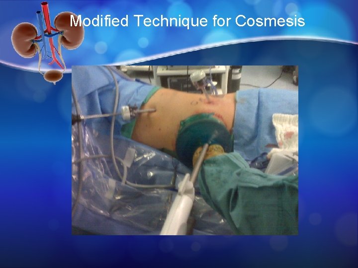 Modified Technique for Cosmesis 