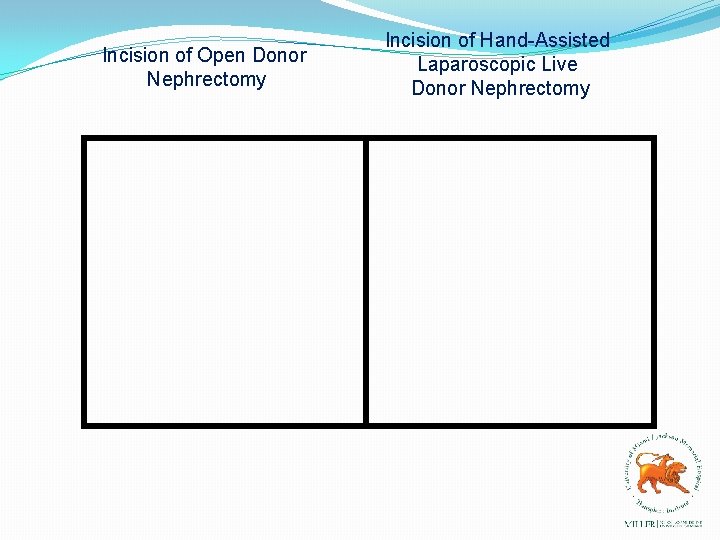 Incision of Open Donor Nephrectomy Incision of Hand-Assisted Laparoscopic Live Donor Nephrectomy 