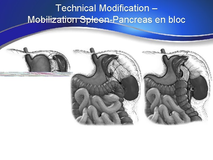 Technical Modification – Mobilization Spleen-Pancreas en bloc 