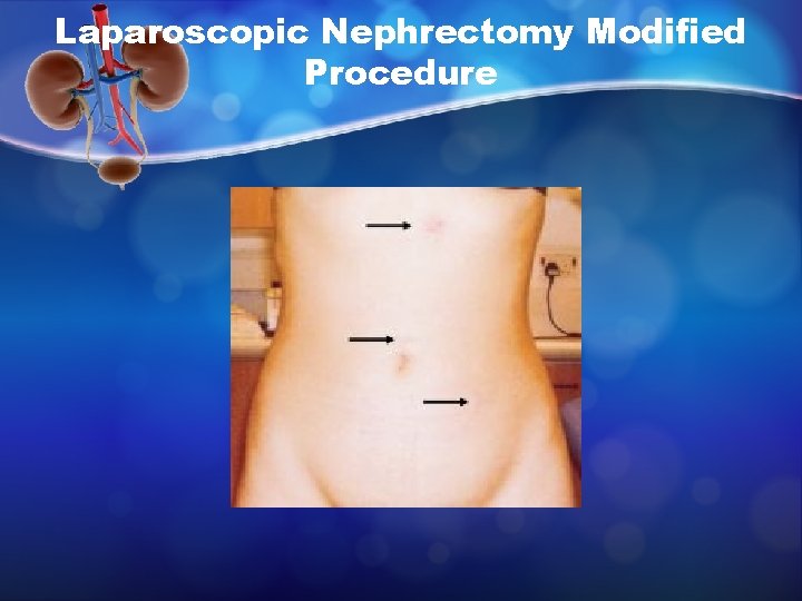 Laparoscopic Nephrectomy Modified Procedure 