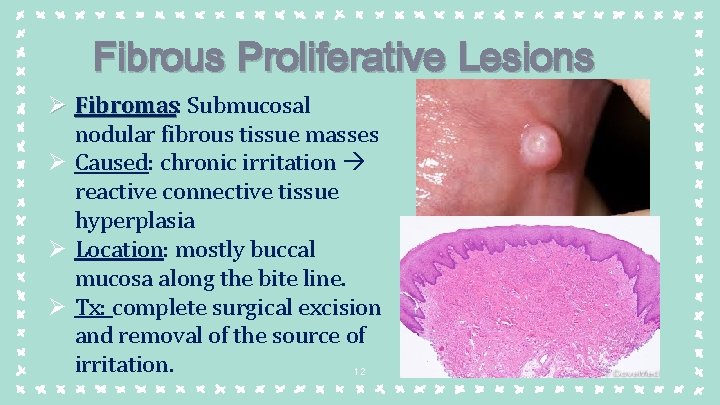 Fibrous Proliferative Lesions Ø Fibromas: Fibromas Submucosal nodular fibrous tissue masses Ø Caused: chronic