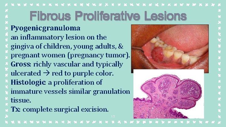 Fibrous Proliferative Lesions Pyogenic granuloma: an inflammatory lesion on the gingiva of children, young