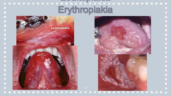 Leukoplakia Erythroplakia 15 