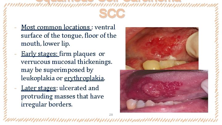 Squamous Cell Carcinoma SCC ‐ Most common locations : ventral surface of the tongue,