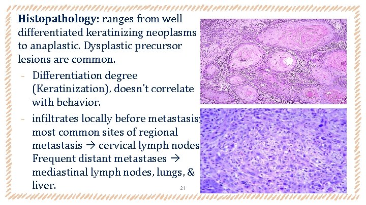 Histopathology: ranges from well differentiated keratinizing neoplasms to anaplastic. Dysplastic precursor lesions are common.