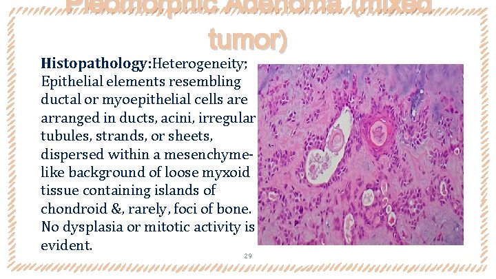 Pleomorphic Adenoma (mixed tumor) Histopathology: Heterogeneity; Epithelial elements resembling ductal or myoepithelial cells are