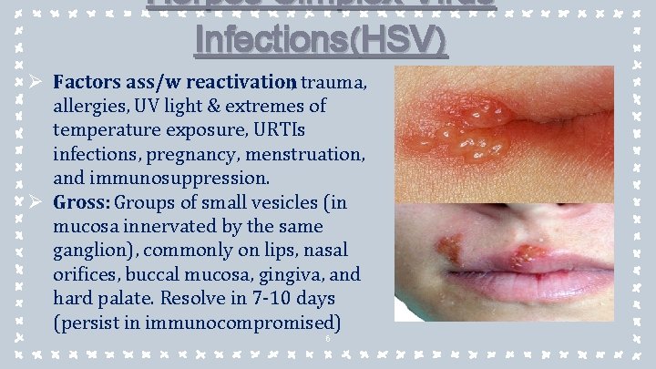 Herpes Simplex Virus Infections(HSV) Ø Factors ass/w reactivation; trauma, allergies, UV light & extremes