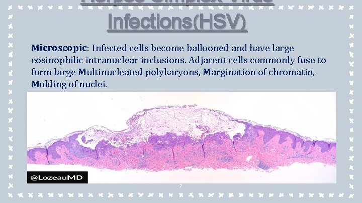 Herpes Simplex Virus Infections(HSV) Microscopic : Infected cells become ballooned and have large eosinophilic