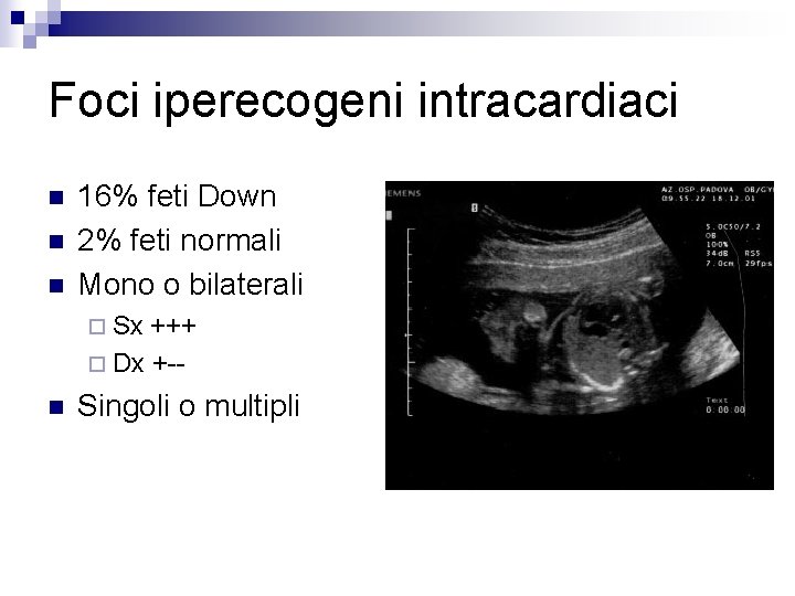 Foci iperecogeni intracardiaci n n n 16% feti Down 2% feti normali Mono o