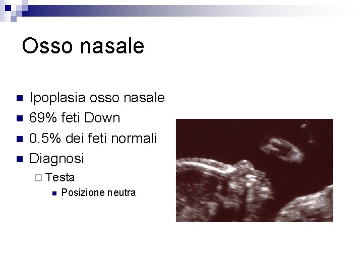 Osso nasale n n Ipoplasia osso nasale 69% feti Down 0. 5% dei feti