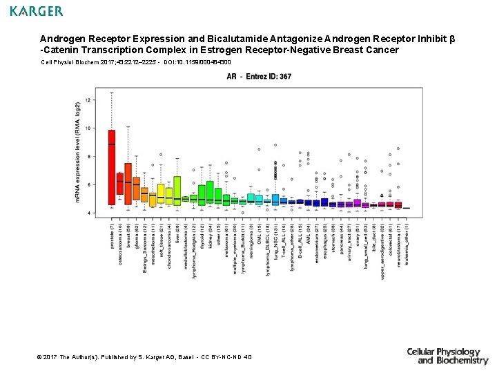 Androgen Receptor Expression and Bicalutamide Antagonize Androgen Receptor Inhibit β -Catenin Transcription Complex in