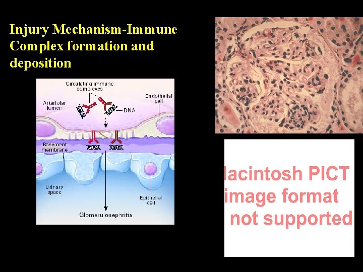 Injury Mechanism-Immune Complex formation and deposition 