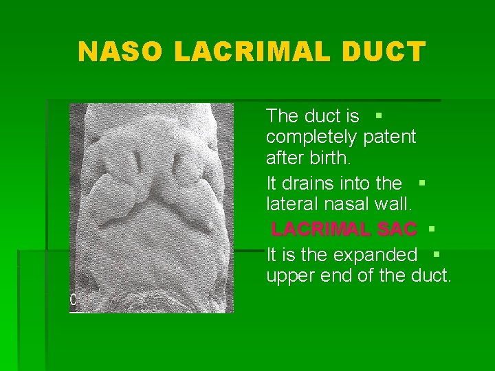 NASO LACRIMAL DUCT The duct is § completely patent after birth. It drains into