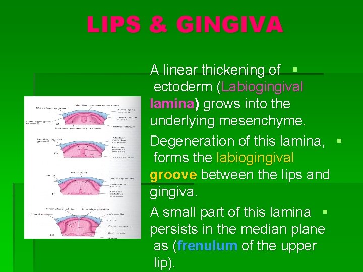 LIPS & GINGIVA A linear thickening of § ectoderm (Labiogingival lamina) grows into the