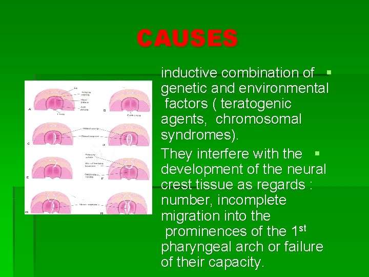 CAUSES inductive combination of § genetic and environmental factors ( teratogenic agents, chromosomal syndromes).
