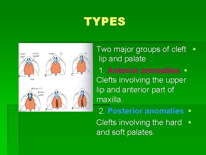 TYPES Two major groups of cleft § lip and palate : 1. Anterior anomalies