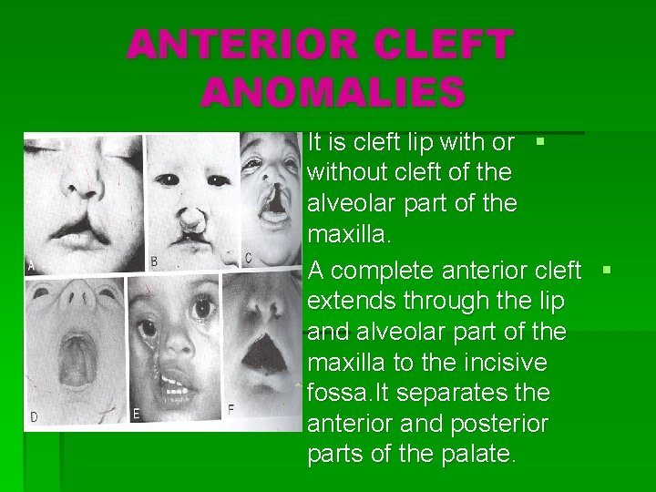 ANTERIOR CLEFT ANOMALIES It is cleft lip with or § without cleft of the